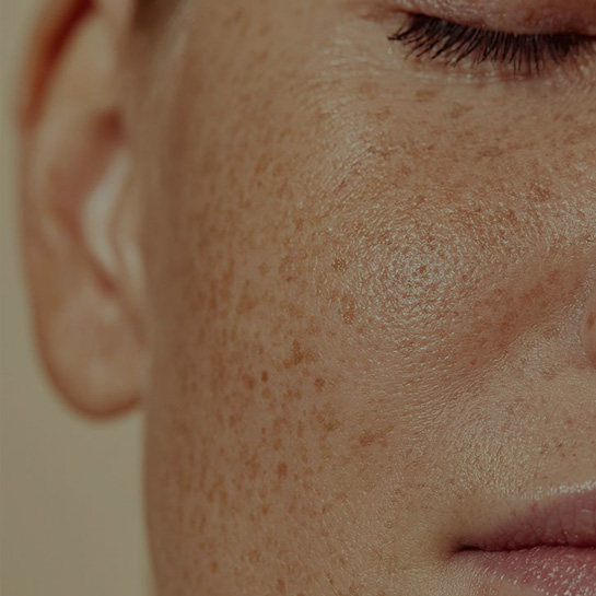 Melasma