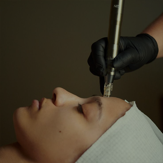 Microneedling