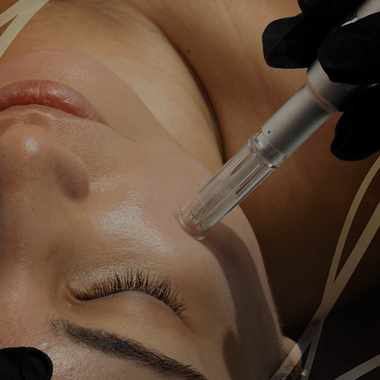 Dermapen con PRP
